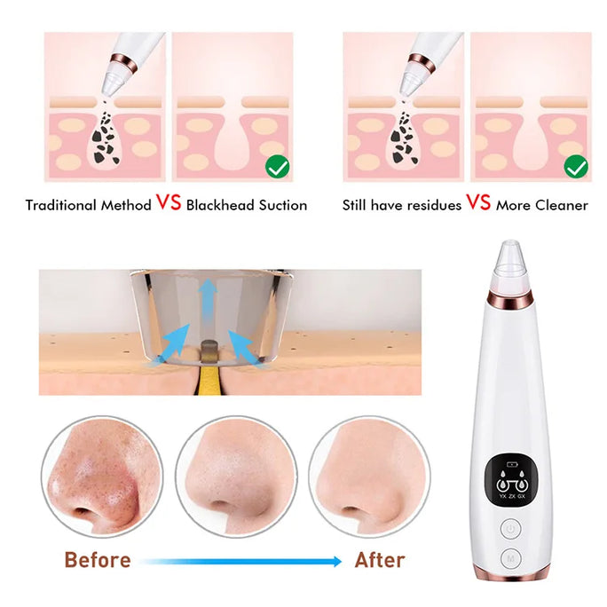 Electric Blackhead Remover -  Acne & Pore Cleaner Machine