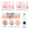 Electric Blackhead Remover -  Acne & Pore Cleaner Machine